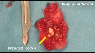 Dr Aghyad  Dentigerous cyst of mandible  excisional biopsy [upl. by Mcgregor]