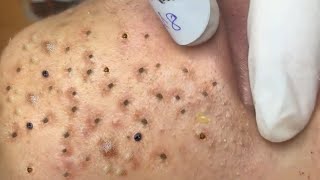 Big Cystic Acne Blackheads Extraction Blackheads amp Milia Whiteheads Removal Pimple Popping  3994 [upl. by Nage]