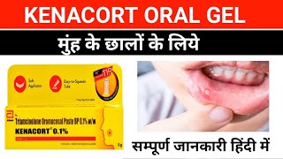 मुंह के छालों का इलाज  kenacort 01 gel  triamcinolone acetonide oromucosal gel  mouth ulcer [upl. by Kellda]