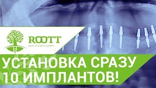 Имплантация всех зубов💉 Как проходит операция по имплантации всех зубов ROOTT [upl. by Elsbeth]