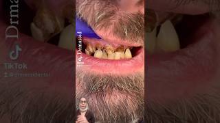 Upper complete denture [upl. by Paynter]