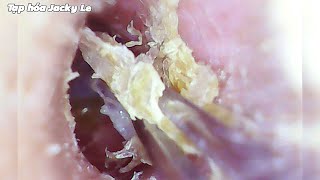 Ear Wax Removal 86 Removes Thick And Dry Earwax Easily  Ear Cleaning ASMR [upl. by Kitrak]