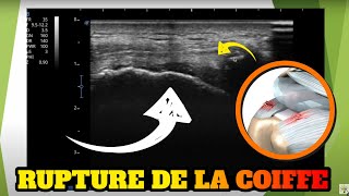 Echographie dune rupture de la coiffe des rotateurs [upl. by Campman]