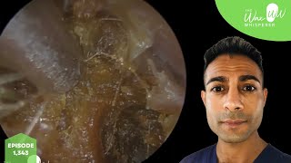 1343  Fully Blocked Dead Skin amp Ear Wax Removal [upl. by Eidak]