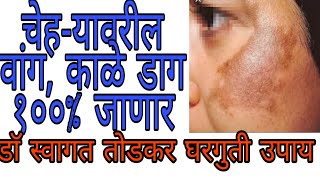 वांग घालविण्यासाठी ३ घरगुती उपाय dr swagat todkar gharguti upayVang ghalavanehow toremove melasma [upl. by Hailahk]