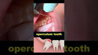 Operculum tooth treatment dentist dentistry wisdomtooth [upl. by Ehrlich293]