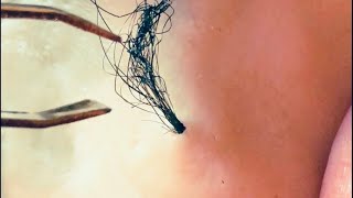 Removal of ingrown hair [upl. by Corena659]