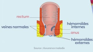 Santé  Tout sur les hémorroïdes [upl. by Babcock803]