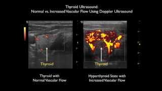 Thyroid Evaluation in a Patient with Thyrotoxicosis with Bedside Ultrasound [upl. by Kecaj333]