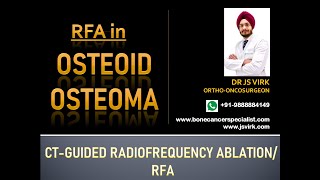 OSTEOID OSTEOMA  RFA IN OSTEOID OSTEOMA  OSTEOID OSTEOMA IN TIBIA BONE  CTGUIDED RF ABLATION [upl. by Proudfoot]