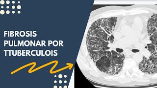 FIBROSIS PULMONAR A CONSECUENCIA DE TUBERCULOSIS Tos cronica Dificultad Respiratoria [upl. by Isla]