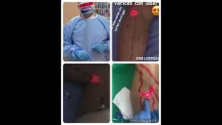 Endovenous laser ablation [upl. by Bilow]