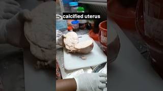 calcified uterus  histopathology [upl. by Berky]