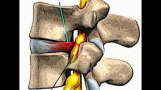 LUMBALGIA  LUMBOCIATALGIA CAUSAS DE LAS LESIONES [upl. by Nomis906]