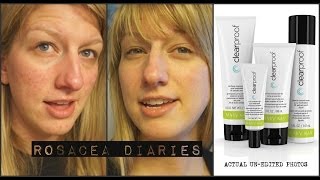 Mary Kay Clear Proof Review  Rosacea Diaries [upl. by Croix]