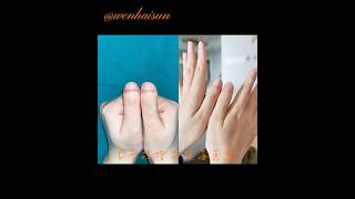 Brachydactyly type D toethumbs clubbed thumbs stubby thumbs brachydactyly [upl. by Ailed]