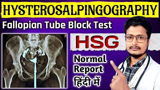 HSG Report Kaise Dekhe  HSG Test Painful Or Not In Hindi  HSG Test Kya Hota Hai  HSG Test Video [upl. by Ielarol495]