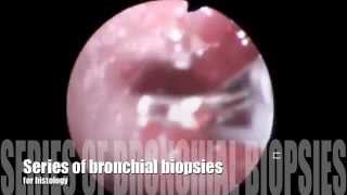 bronchial biopsy [upl. by Sil]