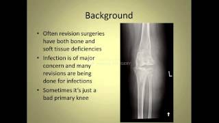 Complexities of Knee Replacement [upl. by Alinna214]