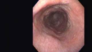 Achalasia Vs Pseudoachalasia [upl. by Bennie648]