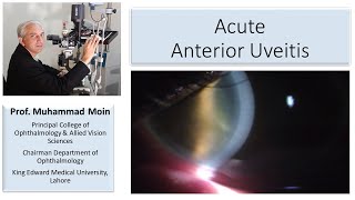 What do you see in Acute Anterior Uveitis [upl. by Gaelan]