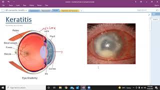 Keratitis  types of keratitis  Ophthalmology  USMLE step 1 [upl. by Madalena]