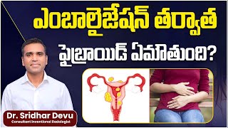 What Happens to Fibroid after Embolization  Treatment for Uterine Fibroids  Dr Devu [upl. by Sonahpets]