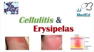 Cellulitis vs Erysipelas  Bacterial Causes Risk Factors Signs and Symptoms Treatment [upl. by Angeline30]