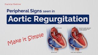 Making Bedside Diagnosis Easy Peripheral Signs in Aortic Regurgitation [upl. by Ibrad]