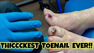 DEBRIDEMENT OF THE THICKEST TOENAILS EVER [upl. by Broder]