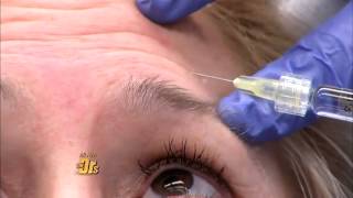 The DRs Show Watch how Belotero changes your under eye appearance [upl. by Atnahs283]