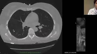 Catamenial pneumothorax review of peritoneal flow  Dr Aarti Sekhar [upl. by Ashly]