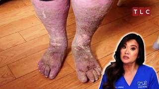 Sandra’s Fight Between Life and Death  Dr Pimple Popper  TLC [upl. by Jaella74]