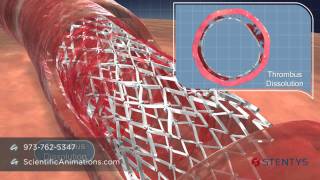 3D Medical Animation of Coronary Stent Procedure [upl. by Nesta]