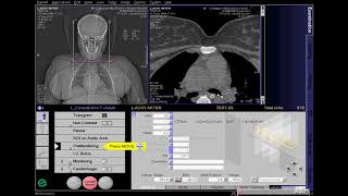 CT Carotid Angio Full Work Process SIEMENS in syngo acquisition workplace [upl. by Anilos]