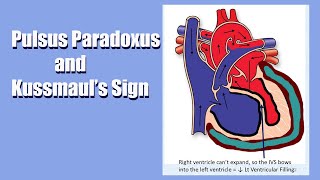 Pulsus Paradoxus amp Kussmauls Sign A Sign of Heart Trouble A Live Lecture [upl. by Ordnael]