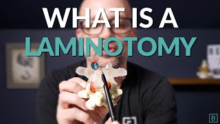 What is a Laminotomy  Spine Surgery Basics [upl. by Tomlin]