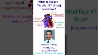 What is Blalock  Taussig BT shunt operation [upl. by Esila]