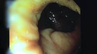 Video of a Colonoscopy [upl. by Compte857]