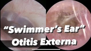 Otitis Externa  Swimmers Ear  infection of the outer ear ear canal [upl. by Arait]