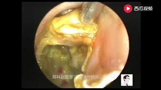 Cleaning of external auditory canal cholesteatoma and fungal otitis externa [upl. by Baumann]