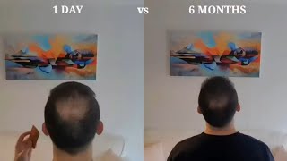 How to Derma Roll for Hair Regrow  My Half a Year Results [upl. by Garlan281]