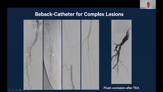 BeBack in Complex Lesions [upl. by Dinsdale]