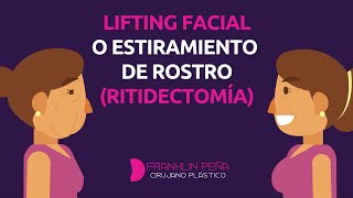 Lifting facial o estiramiento del rostro  ¿de qué se trata 🤔 [upl. by Eihcir]