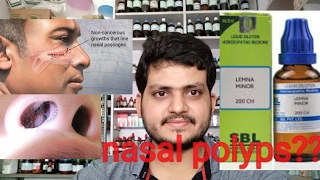 Nasal polypsHomeopathic medicine for nasal polyps explain [upl. by Ellekram]