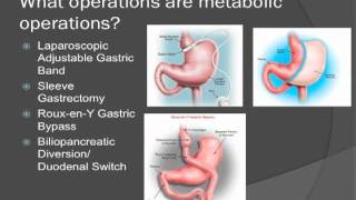 Metabolic Surgery [upl. by Beichner]