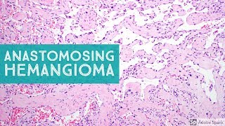 Anastomosing Hemangioma 101Explained by a Soft Tissue Pathologist [upl. by Padegs158]