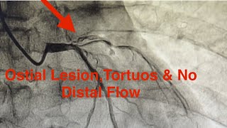 Acute Extensive Anterior MI Ostial Lesion at LAD Tortuous No Distal Flow Guidewire Tricks [upl. by Mast266]