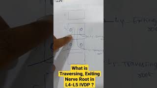 What is Traversing Exiting Nerve Root in L4L5 IVDP  Dr Sai Chandra MBBS DNB Ortho [upl. by Latea]