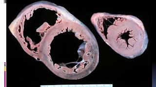 Cardiomyopathies in echocardiograpghy Dr Ahmed Onsy [upl. by Rist40]